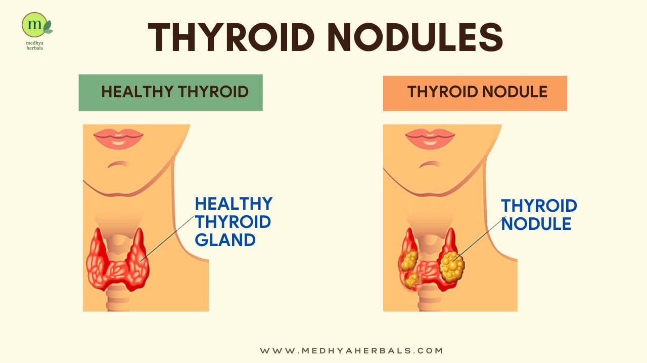 complete-ayurvedic-treatment-to-shrink-thyroid-nodules-naturally