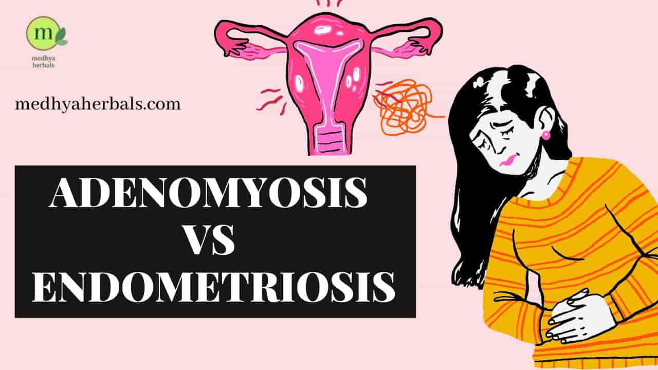 Adenomyosis Vs Endometriosis Treatment Symptoms Stages-min