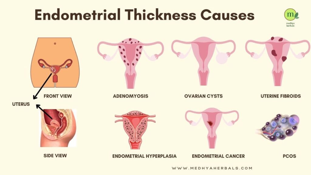 Endometrial Thickness Causes-min