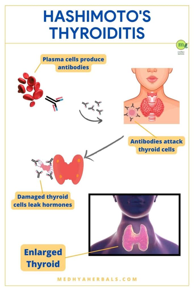 Hashimoto's Thyroiditis-min