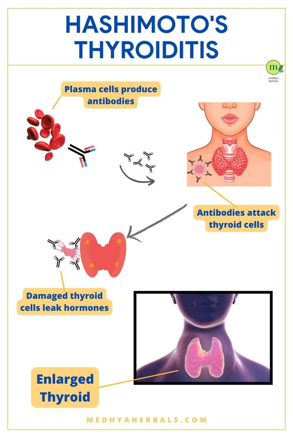 Hashimoto's Thyroiditis Ayurvedic Treatment Doctor's Guide