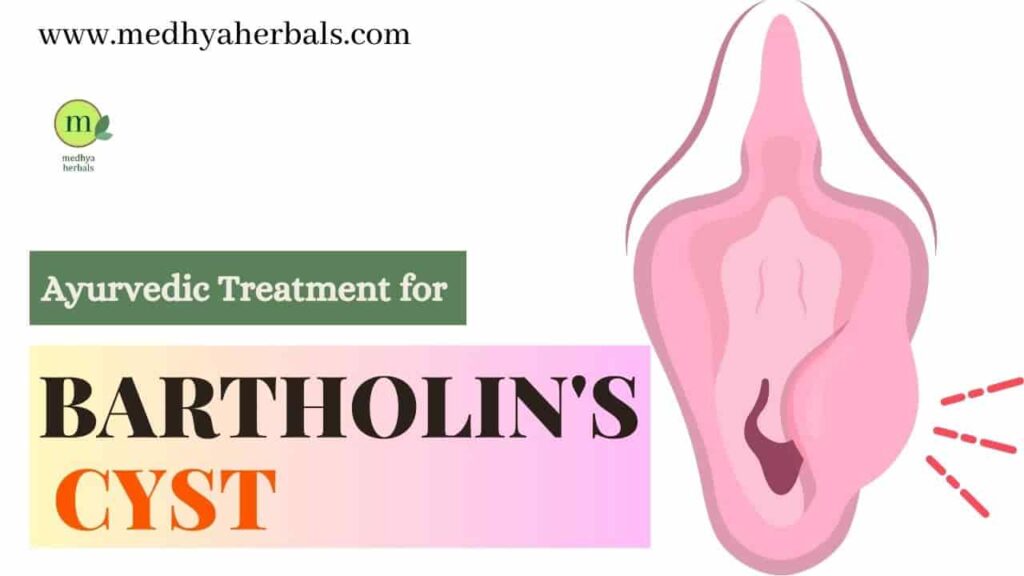 Bartholins Cyst Treatment An Ayurvedic Doctors Guide 9064