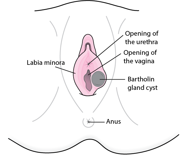 Bartholin's Cyst