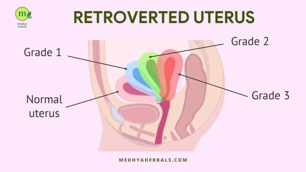 Retroverted Uterus Grades