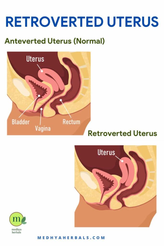 Retroverted Uterus