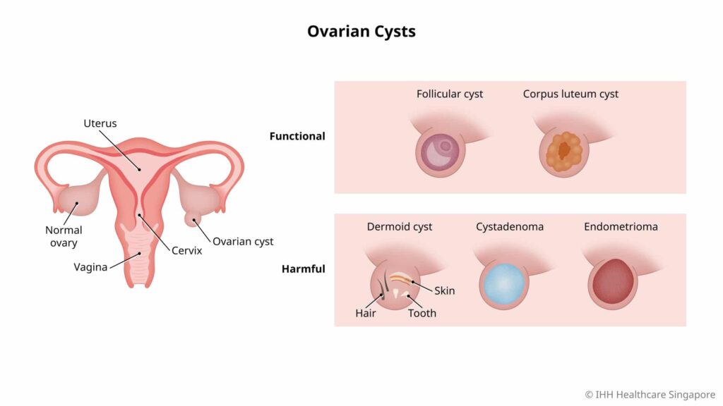 Ovarian Cysts-min