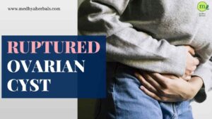 Ruptured Ovarian Cyst